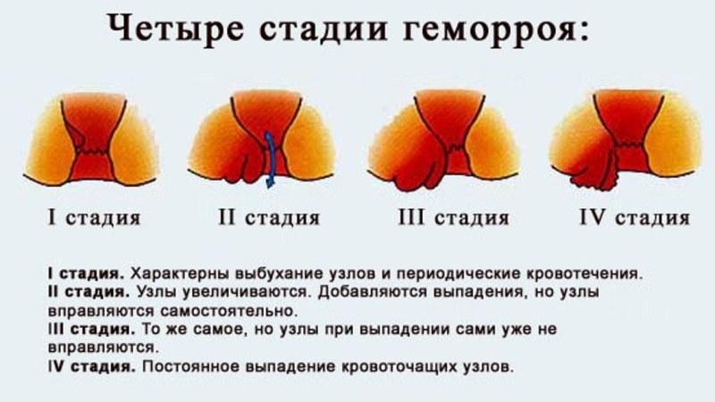 1 стадия геморроя фото