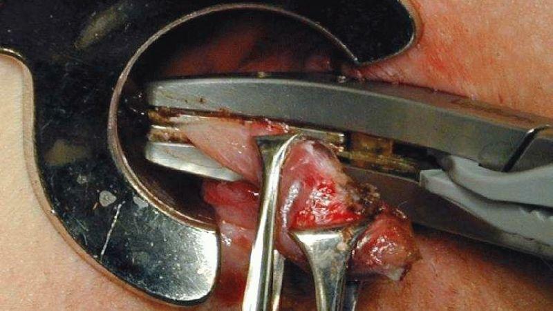 что такое геморрой и какие у него симптомы