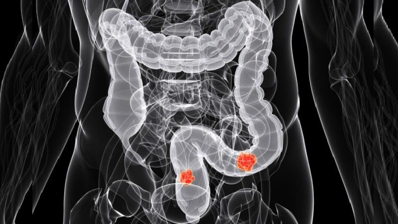 первые симптомы рака прямой кишки