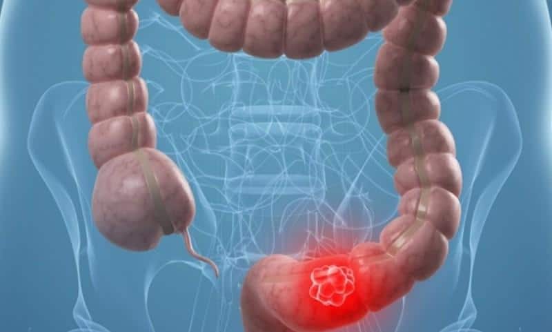 рак прямой кишки симптомы и первые признаки
