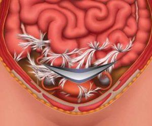 Что такое пневматоз толстой кишки и его лечение