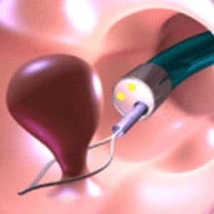 лечение полипов прямой кишки чистотелом