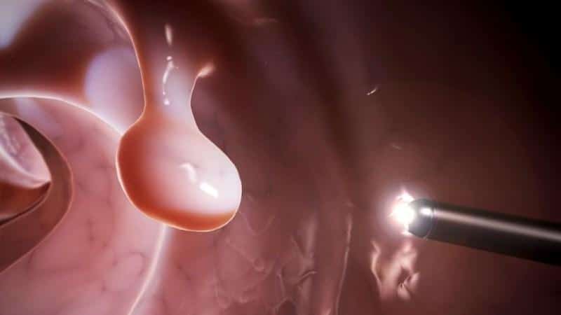 фото полипы заднего прохода