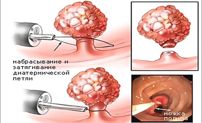 размеры полипов в прямой кишке