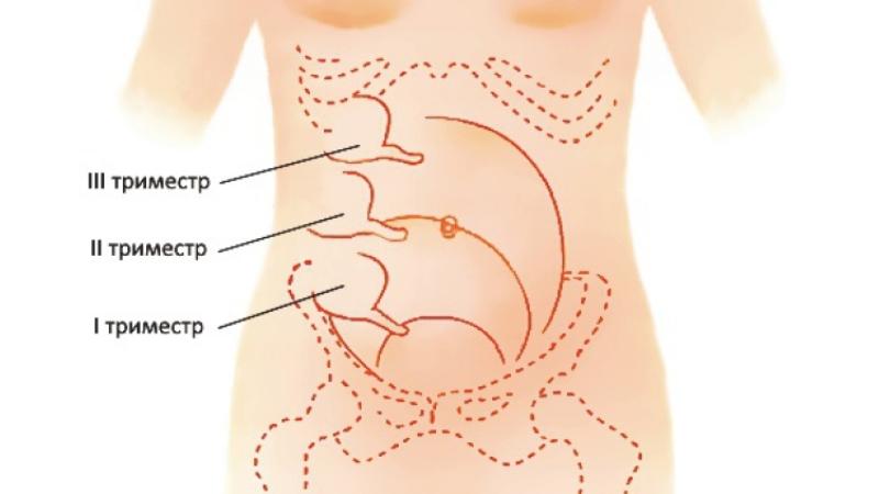 колит слева низ живота при беременности