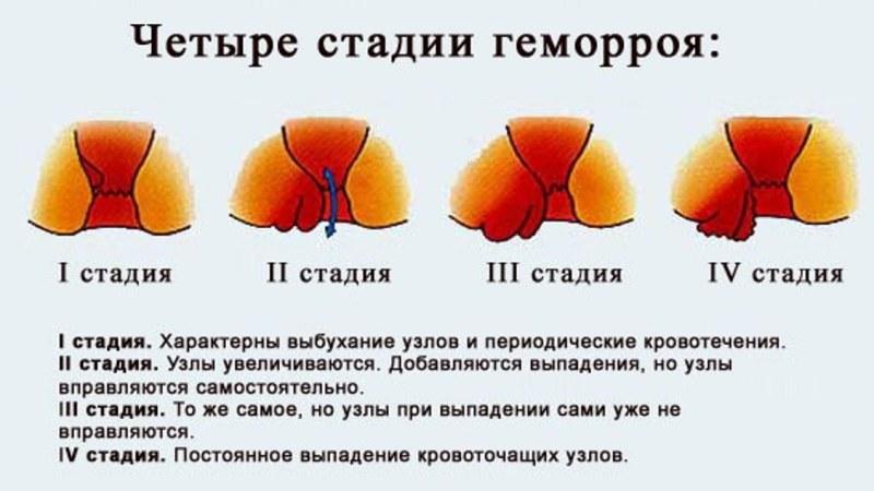 что делать если кровоточит геморрой в домашних условиях