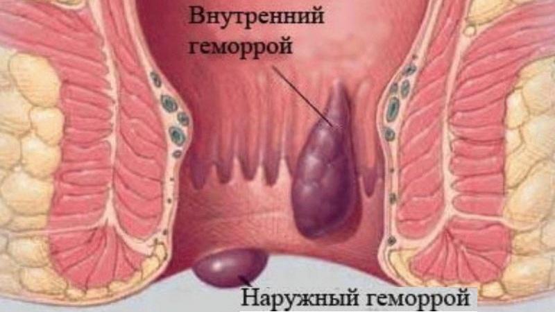 если геморрой кровоточит что делать