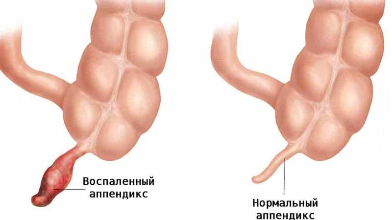 может ли подняться температура у ребенка из за запора