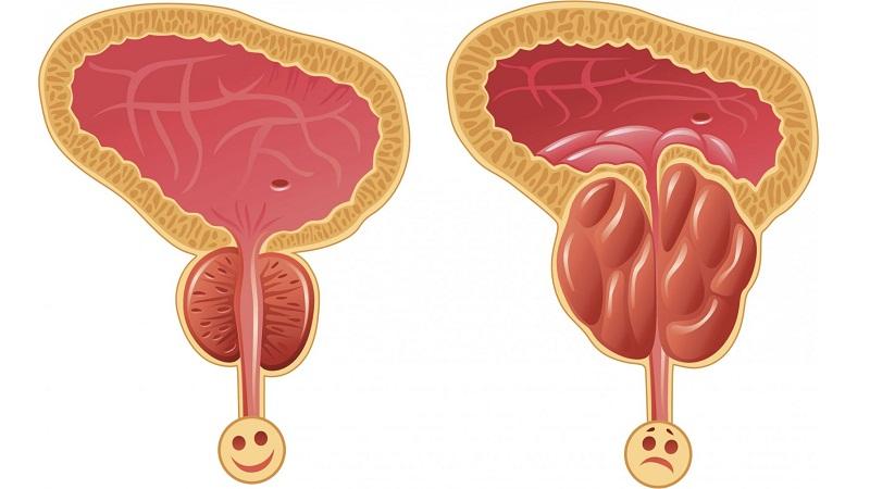 причины возникновения простатита у мужчин