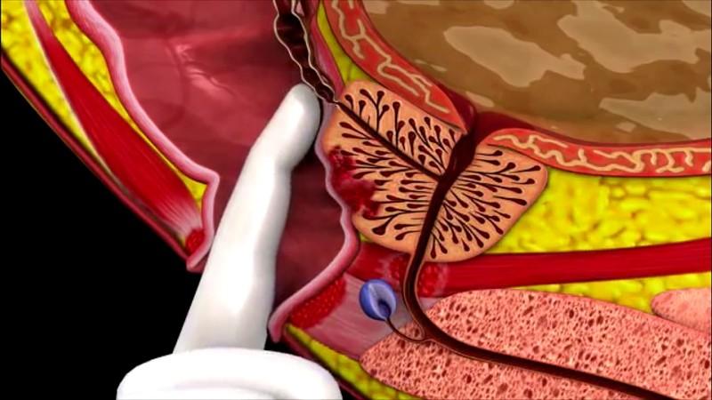 от чего появляется простатит у мужчин