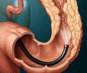 симптомы рака кишечника и прямой кишки у женщин