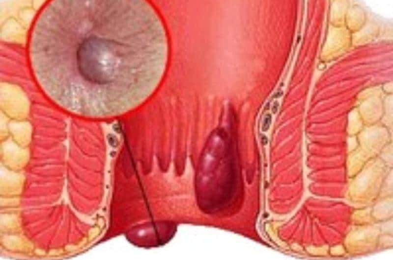 мазь для профилактики геморроя