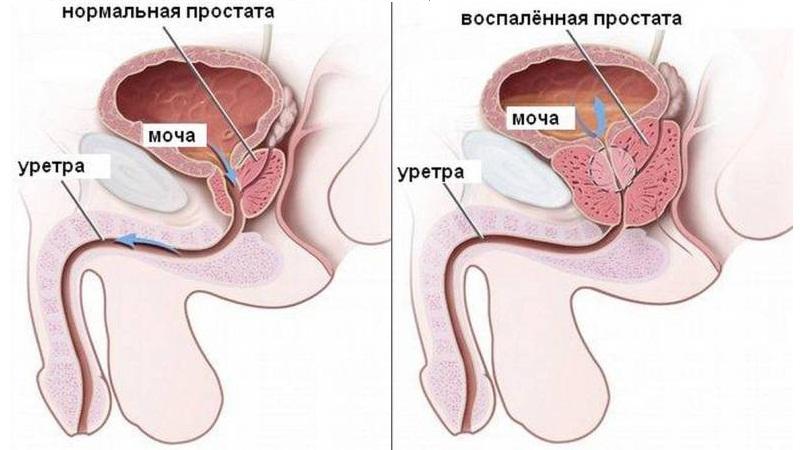 лечение простатита и хронического простатита