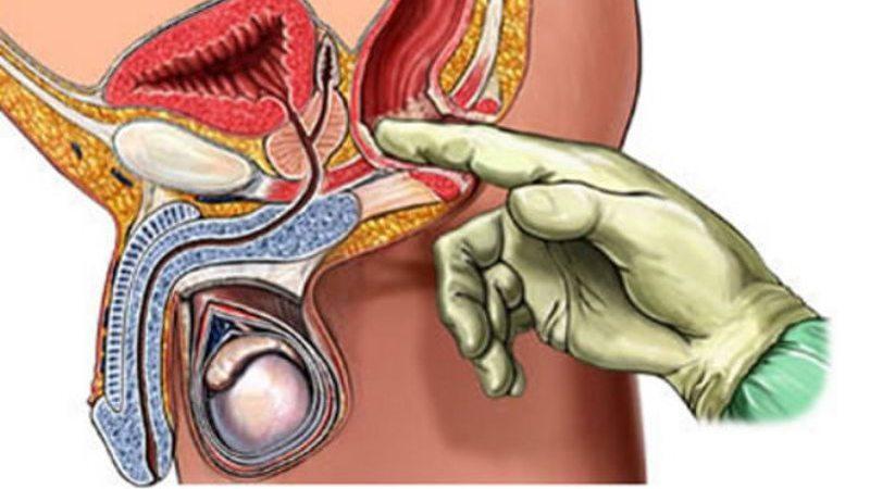 хронический простатит симптомы и лечение
