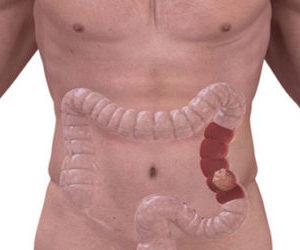 прогнозы после операции рака прямой кишки