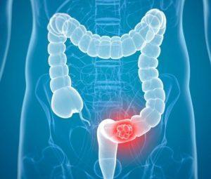 аденокарцинома прямой кишки прогноз выживаемости без операции