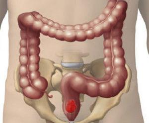рак 4 степени прямой кишки с метастазами сколько живут