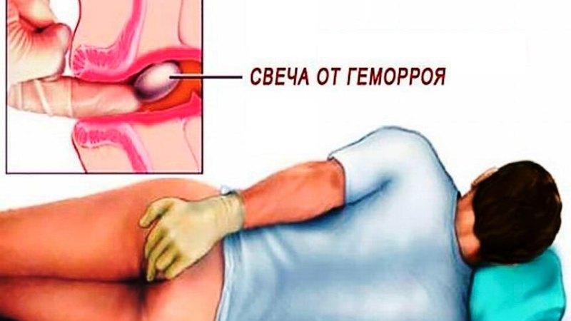инструкция свечи от геморроя