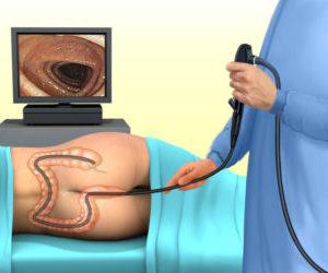 ректороманоскопия при геморрое