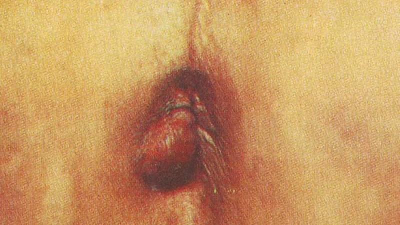 самое лучшее средство от геморроя