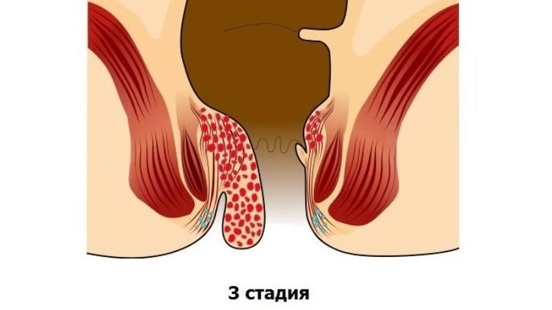 лечение геморроя лекарственными препаратами