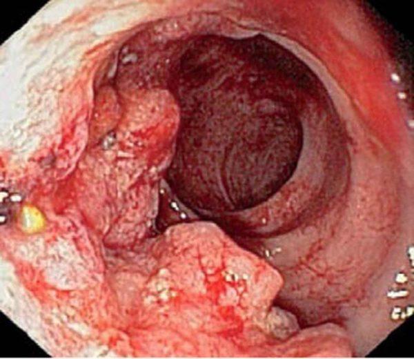 сфинктерит прямой кишки симптомы лечение