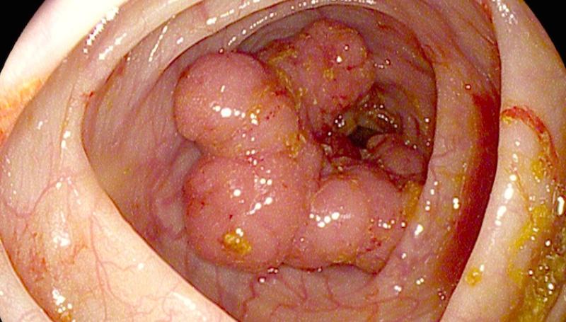 в заднем проходе появилась шишка фото