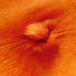 уплотнение возле заднего прохода у взрослого