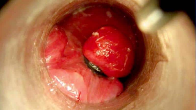 шишка в прямой кишке