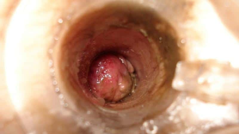 признаки внутреннего геморроя у женщин