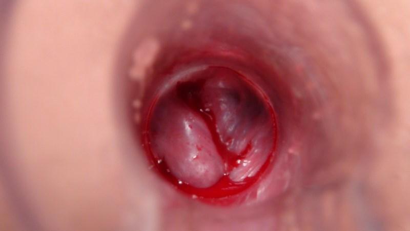 симптомы внутреннего геморроя у женщин как лечить