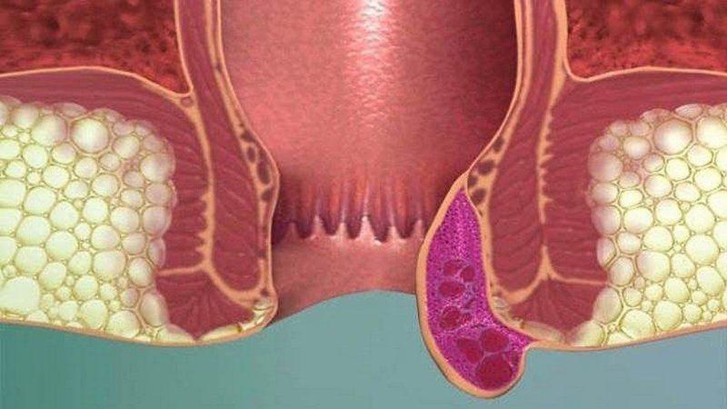 симптомы при геморрое у мужчин