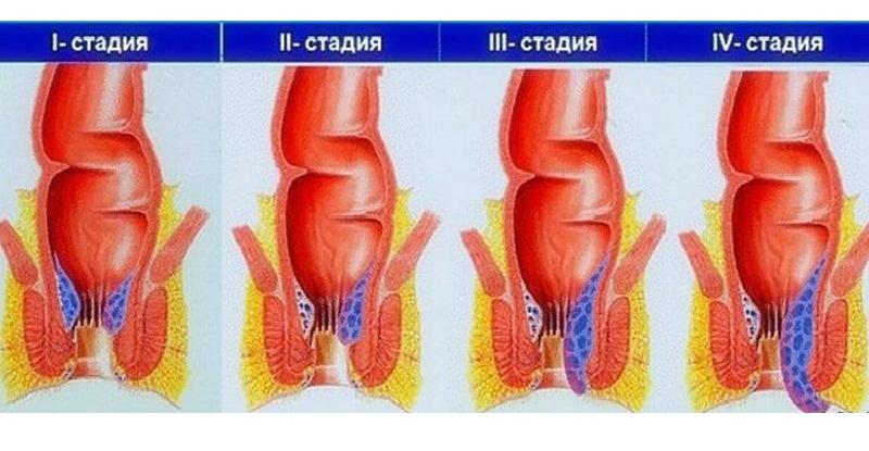 признаки геморроя у мужчин