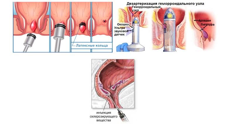 геморрой у мужчин первые признаки