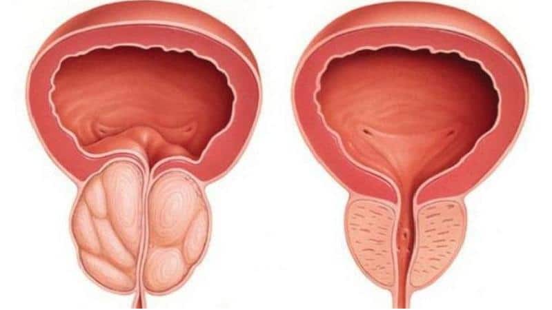 схемы лечения простатита хронического