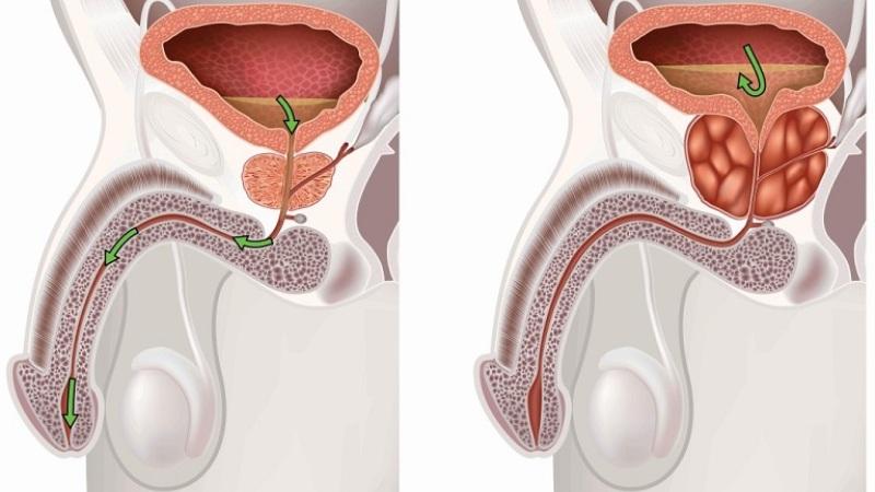 схема лечения простатита антибиотиками