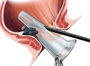 склеротерапия геморроидальных узлов что это такое