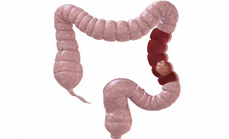 спастический запор что такое