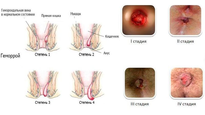 свечи для лечения геморроя