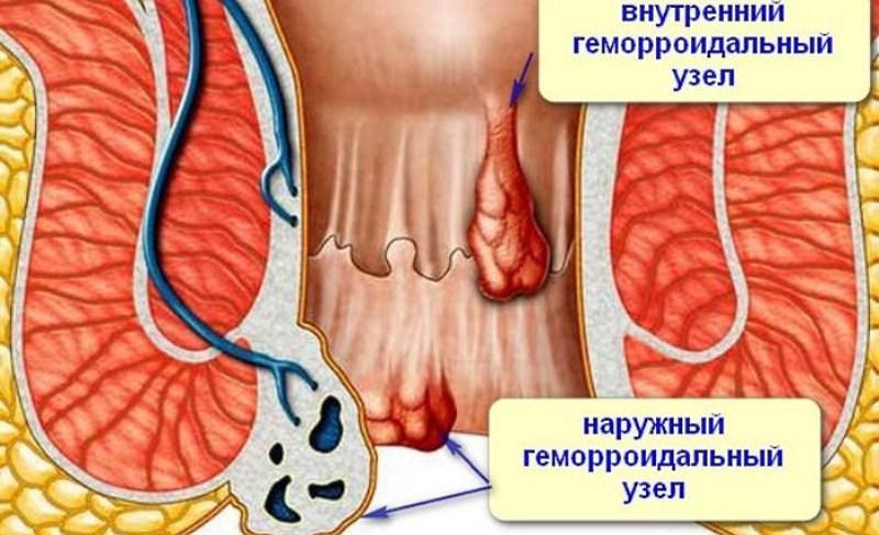 свечи от геморроя релиф инструкция по применению