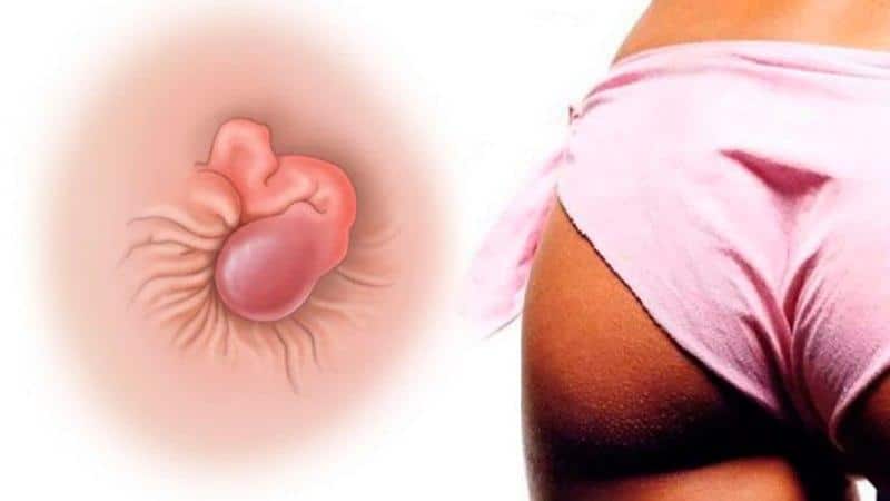 Лечение геморроя свечами с Календулой: инструкция и отзывы