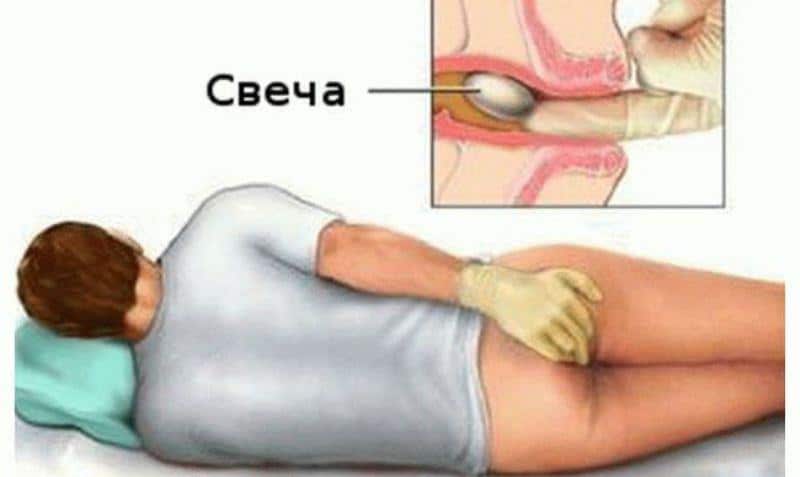 Лечение геморроя свечами с Календулой: инструкция и отзывы