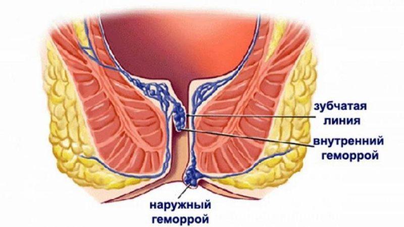 свечи от внутреннего геморроя недорогие и эффективные
