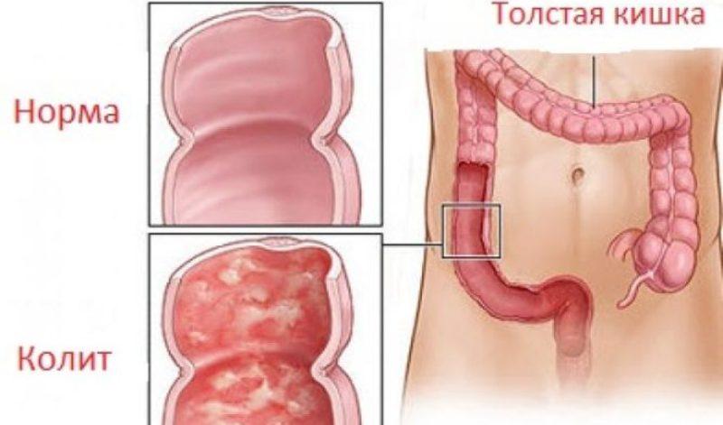 Суппозитории для лечения колита кишечника: названия свечей