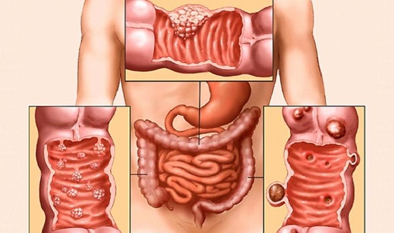 Суппозитории для лечения колита кишечника: названия свечей