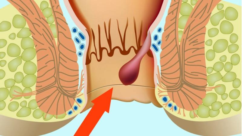 Препарат Прокто-Гливенол: инструкция при лечении геморроя и отзывы