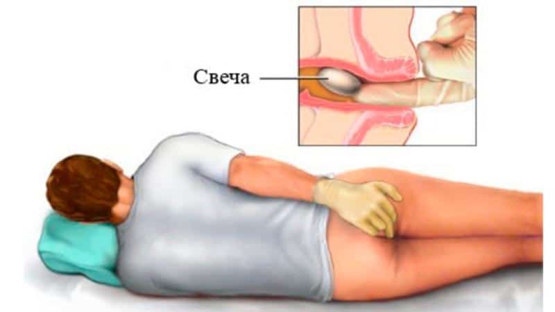 Препарат Прокто-Гливенол: инструкция при лечении геморроя и отзывы