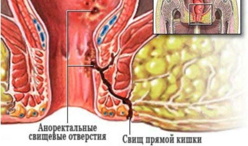 признаки свища в заднем проходе фото