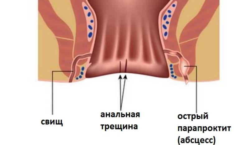 симптомы свища заднего прохода