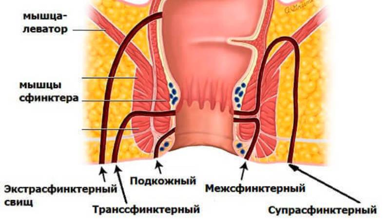 внутренний неполный свищ прямой кишки
